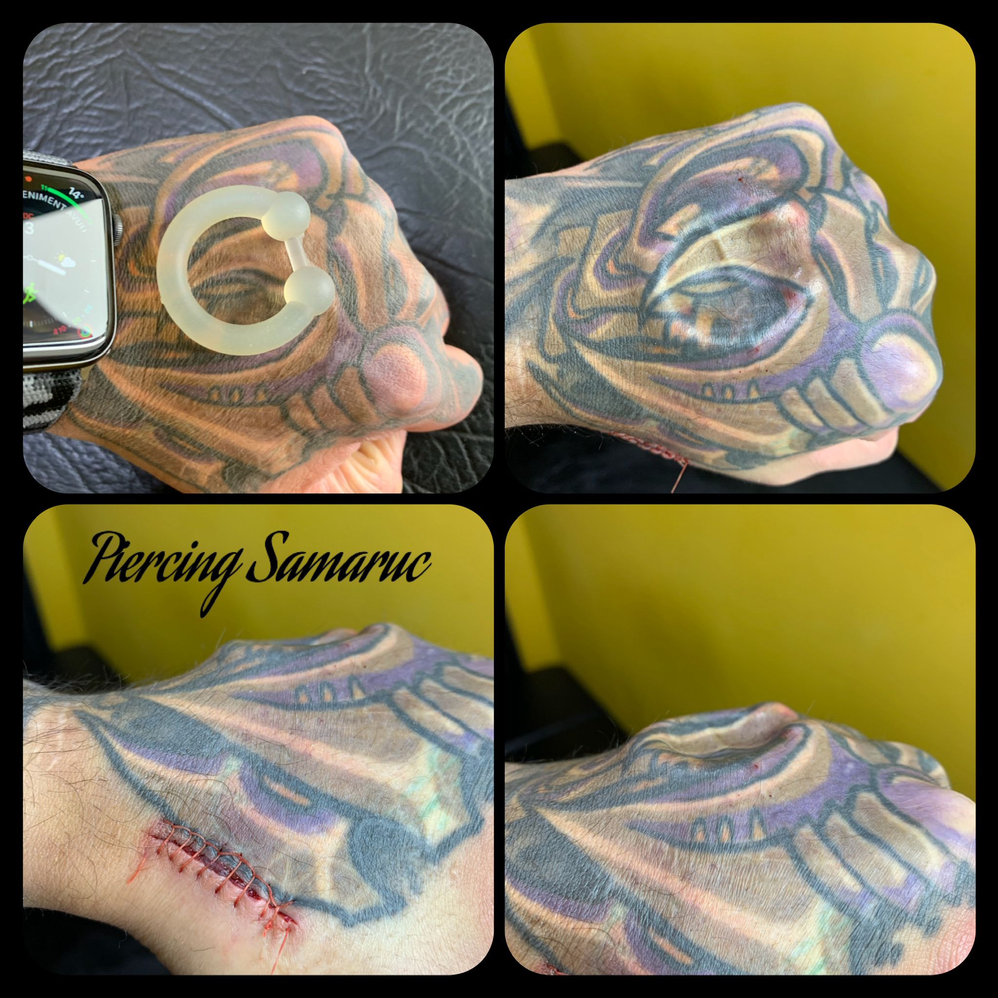 Implantes subdérmicos 3D